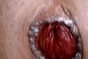 HUGE ANAL PROLAPSE PUMPING 5M