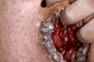 HUGE ANAL PROLAPSE PUMPING 5M